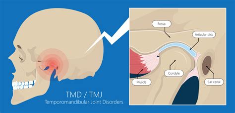 TMJ Treatments: Effective Solutions for Temporomandibular Joint Disorders