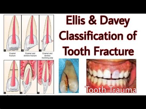 Ellis & Davey Classification of Tooth Fracture / Tooth Trauma /Tooth ...