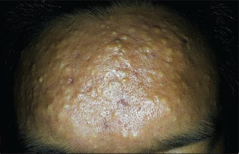 Facial variant of eruptive vellus hair cyst - Indian Journal of Dermatology, Venereology and ...