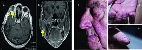 Clinical response to the combination therapy with the cetuximab ...