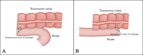 Bowel Resection an Anastomosis - The Operative Review Of Surgery