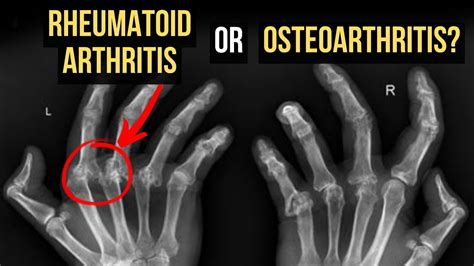 Osteoarthritis Hands X Ray