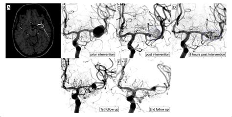 | Endovascular treatment of an MCA aneurysm on the left side. MRI was... | Download Scientific ...