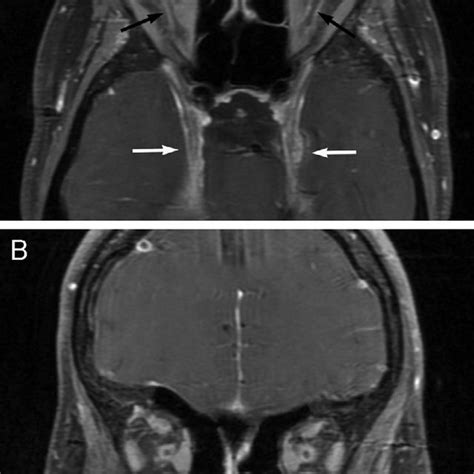 Bilateral optic nerve sheath meningiomas. A: T1-weighted, fatsaturated,... | Download Scientific ...