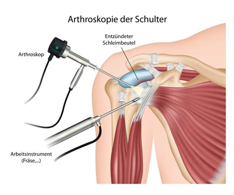 Schulterstechen: Schmerzen im Schultergelenk – Naturheilkunde ...