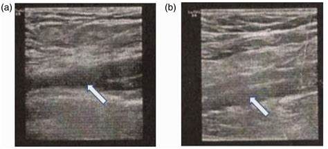 Acute pulmonary embolism presenting with electrocardiographic signs and ...