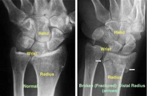 Distal Radius Fractures (Broken Wrist) - OrthoInfo - AAOS