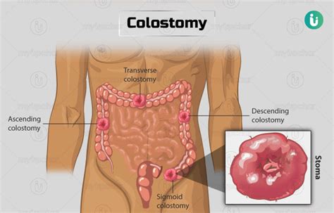 Colostomy: Procedure, Purpose, Results, Cost, Price