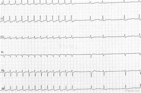 File:Avnrt ecg.jpg - ECGpedia