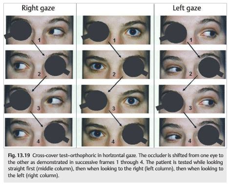 Questions of the Week: Diplopia 2 – Assessment — Neuro-Ophthalmology