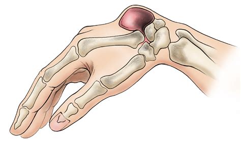 Excision of Ganglion Treatment : GetWellGo - India's Best Healthcare ...