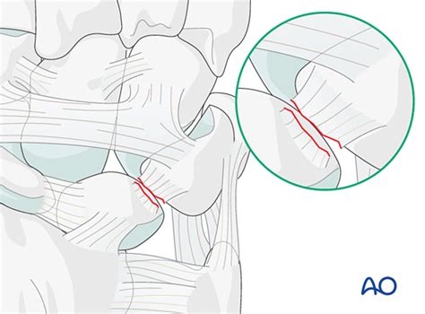 Lunotriquetral ligament repair