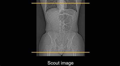 Abdominal CT: Planes • LITFL • Radiology library