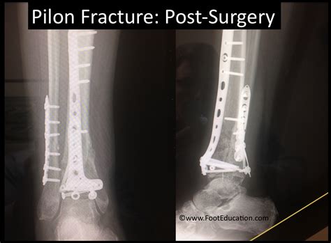 Pilon Fracture - FootEducation