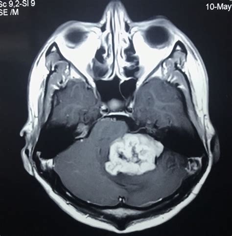 Know About Brain Tumor With Dr. Rajiv Jha Nepal » Prof. Dr. Rajiv Jha