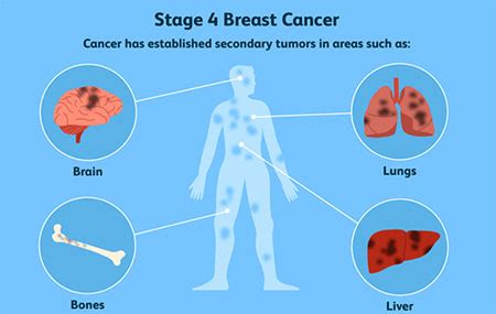 Breast Cancer Recurrence | Breast Cancer Surgery Melbourne, VIC