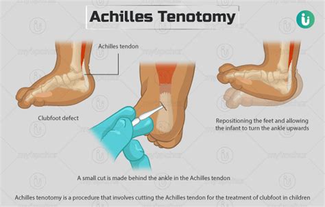 What is the Achilles Tenotomy Surgery? | Non-Surgical Clubfoot ...