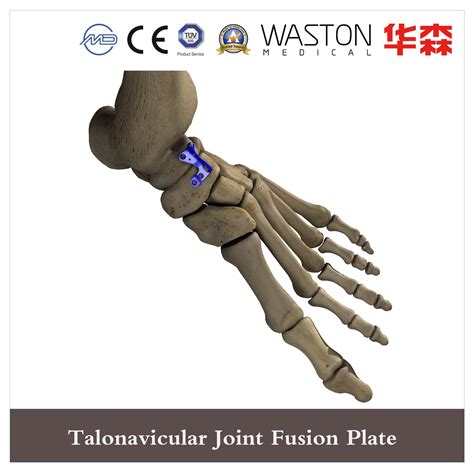 Talonavicular Joint Fusion Locking Plate - Loc Plate and Medical Instrument