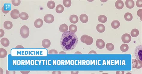 Normocytic Normochromic Anemia: Symptoms, Causes and Treatment