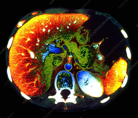 Liver, CT scan - Stock Image - P530/0141 - Science Photo Library