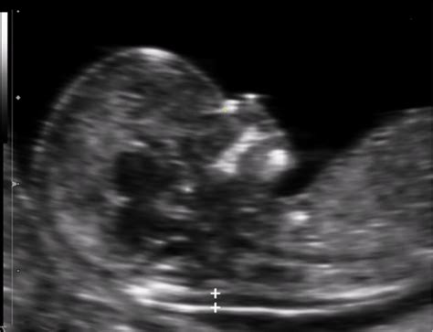 First Trimester Screening for Trisomy 21 by Maternal Age, Nuchal ...