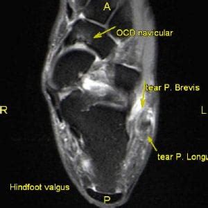 The Best Portland 3T MRI | Peroneus Longus and Peroneus Brevis Tendon Tears: 3T MRI Hindfoot