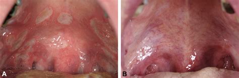 Apremilast for treatment of recalcitrant aphthous stomatitis - JAAD Case Reports