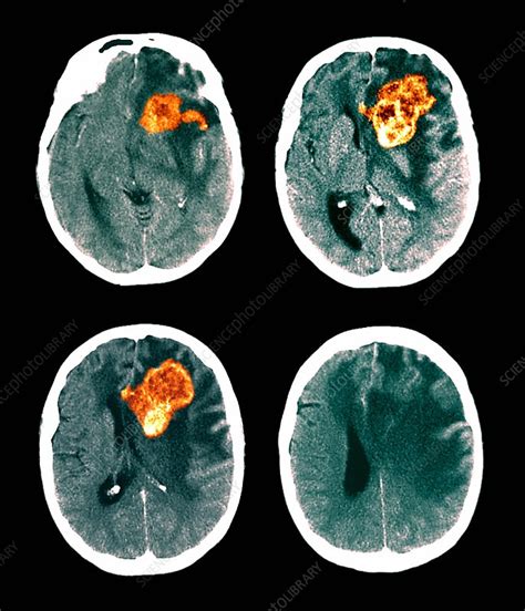 Brain cancer, CT scans - Stock Image - M134/0466 - Science Photo Library