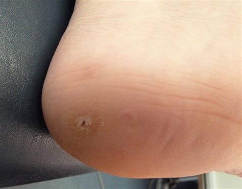 Verruca Pedis Treatment – Warts