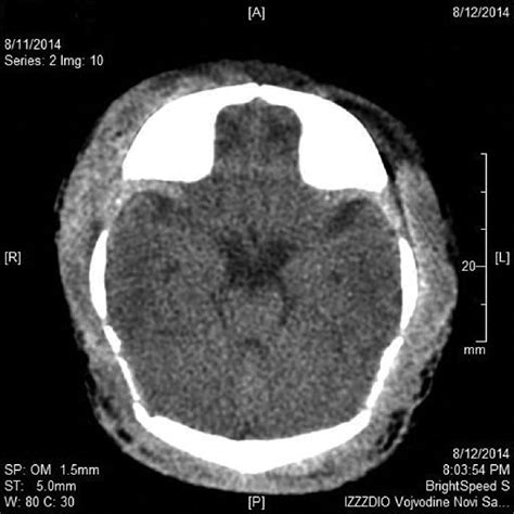 A head CT reveals cerebral edema and massive subgaleal hemorrhage | Download Scientific Diagram