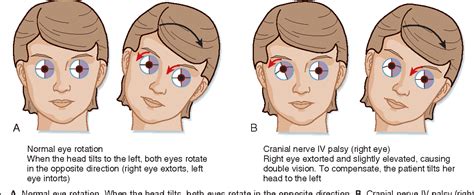 Trochlear Nerve Palsy Eye Position