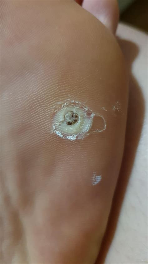 Dear experienced wart removal redditors, at what stage is my verruca at now? I've been using ...