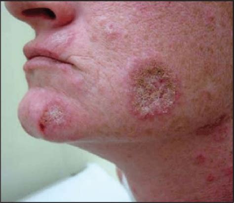 Chronic cutaneous lupus erythematosus. Discoid lupus erythematosus ,... | Download Scientific ...