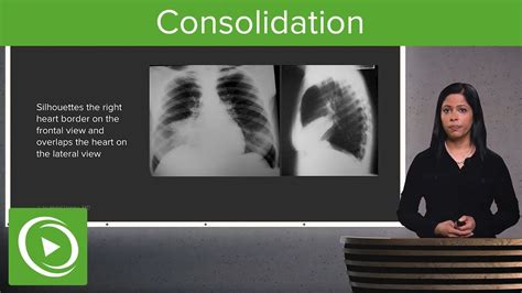 Chest X Ray Consolidation