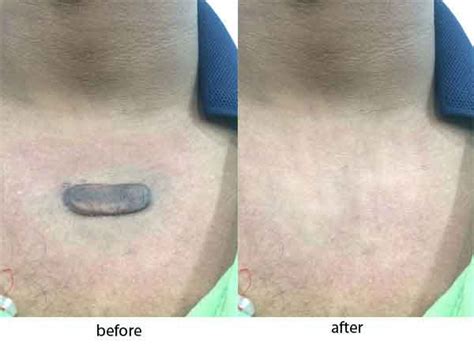 Keloid Removal Treatment Pune - Cryotherapy & Flurouracil bleomycin