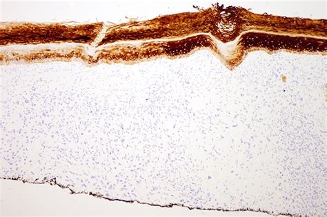 Atypical Fibroxanthoma | Dermatopathology