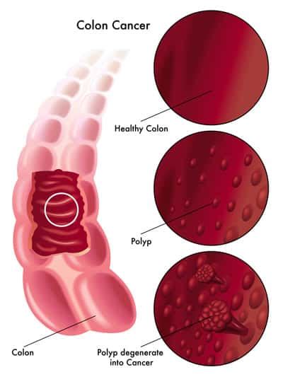 [DIAGRAM] Colon Polyps Diagram - MYDIAGRAM.ONLINE