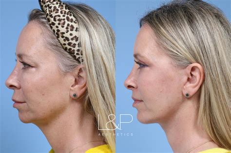 Before and After photos of chin augmentation at L&P Aesthetics in Palo ...