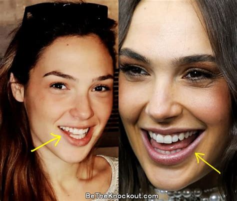 Gal Gadot Plastic Surgery Comparison Photos