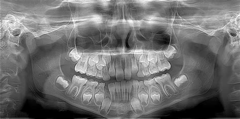 Panoramic Dental X-Ray: Why Get One, Costs, and Procedure - Dentaly.org