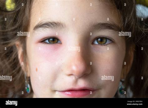 A red swollen eyelid on a child face in close-up is an allergy to an ...