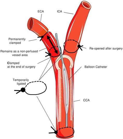 Schematic drawing of the surgical procedure. The balloon catheter is... | Download Scientific ...