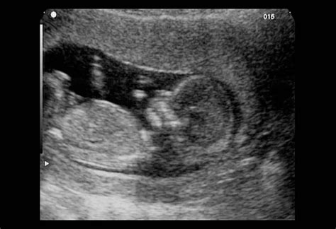 12 Week Ultrasound Girl Vs Boy