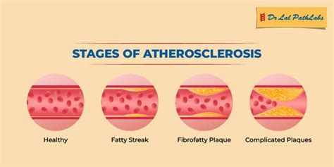 Atherosclerosis: Symptoms & Diagnosis | Dr. Lal PathLabs