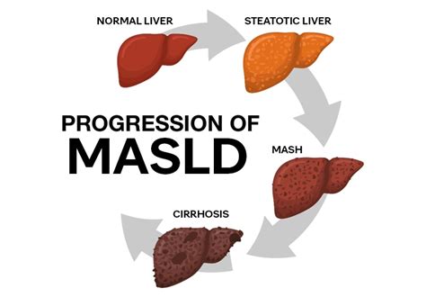 Pediatric metabolic dysfunction-associated steatotic liver disease (MASLD), formerly known as ...