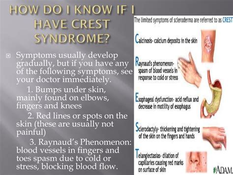 PPT - CREST SYNDROME (Limited Scleroderma) PowerPoint Presentation - ID ...