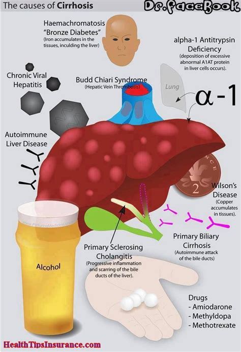 Cirrhosis Of The Liver Caused By Diabetes - DiabetesWalls