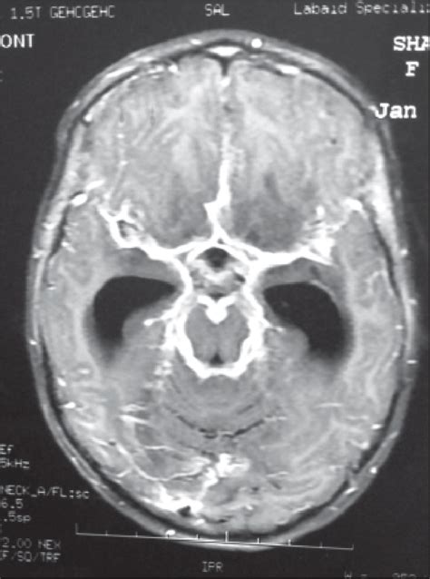 MRI of Brain showing basal cistern enhancement i on contrast enhanced... | Download Scientific ...