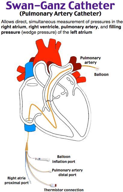 Swan-Ganz Catheter - swan- ganz catheter - cardio- wedge pressure | Icu ...