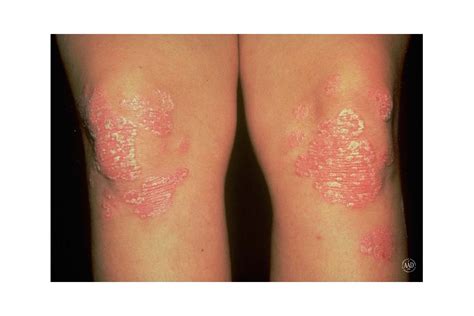 What's that Rash? How to ID Common Rash Symptoms | Reader's Digest